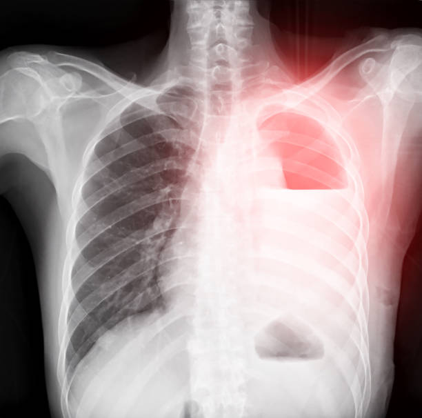 The chest X-ray reveals left-sided pleural effusion, indicating fluid accumulation in the left lung cavity. stock photo