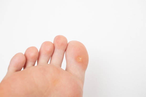 Wart on the big toe foot