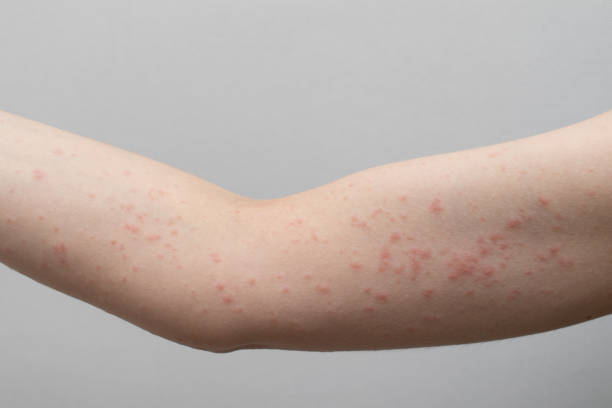 istock Urticaria allergy on the hand 2172153872