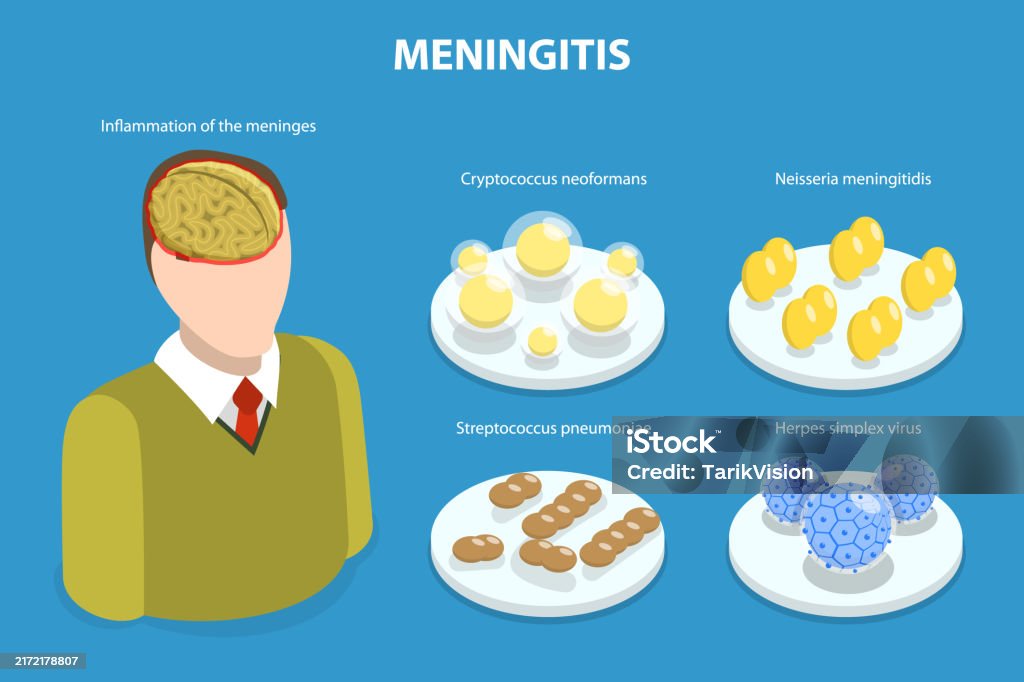 Cartoon Menigitis Rash 3d Isometric Flat Vector Illustration Of Meningitis Stock Illustration ...