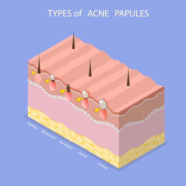 istock 3D Isometric Flat Vector Illustration of Types Of Acne Papules 2172180647