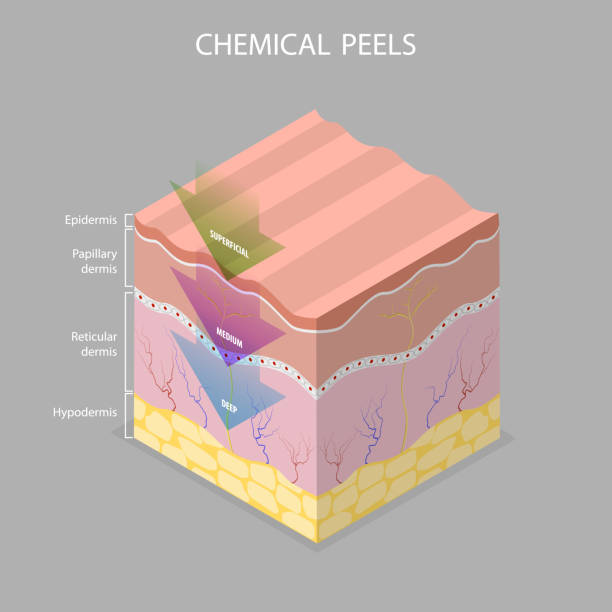 istock 3D Isometric Flat Vector Illustration of Skin Chemical Peel 2172181289