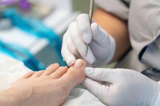 istock Podologist uses a curette to remove a callus on the toe 2172622409