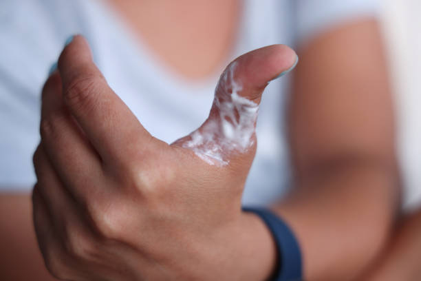 istock Woman who burned her finger put cream on her finger 2172622707
