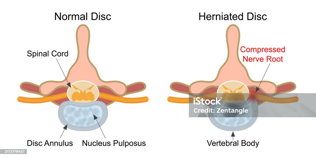 Disk In Spine Herniated Disc Is A Fragment Of The Disc Nucleus Stock Illustration ...