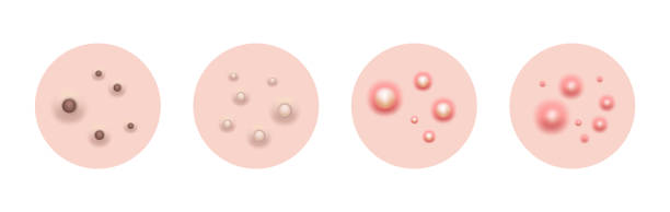 Acne skin pimple, vector illustration Acne skin pimple, vector illustration acne-cartoon stock illustrations