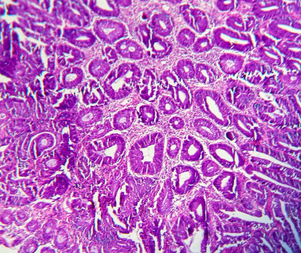 Tubular adenoma with low-grade dysplasia. Microscopic image of an adenoma. Tubular adenoma with low-grade dysplasia. Microscopic image of an adenoma. Colonoscopy can prevent cancer by removing adenomas before they transform into cancer. tubular structures stock pictures, royalty-free photos & images