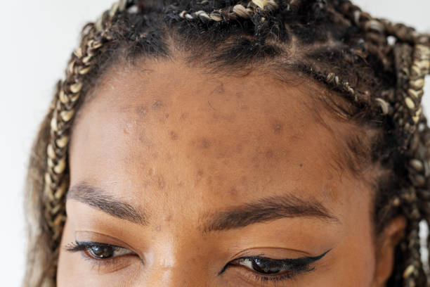 istock Brazilian woman with acne scars on her forehead 2173652741