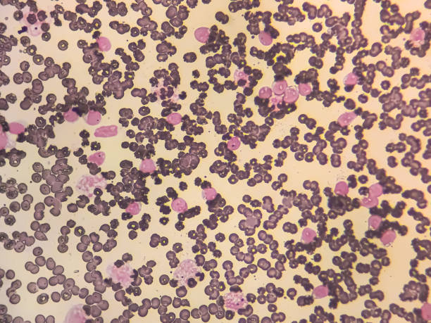 istock Blood smear under microscopy showing on Adult acute myeloid leukemia (AML). 2173676668