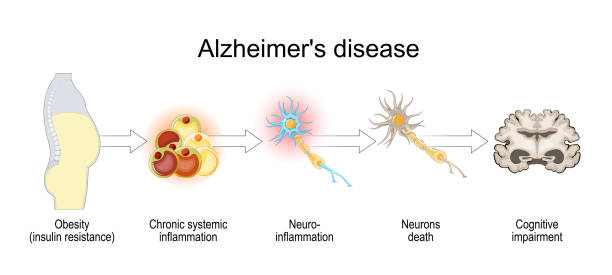Alzheimers disease and insulin resistance. Alzheimers disease and insulin resistance. Cognitive decline. From Obesity, Chronic systemic inflammation to Neurons death after Neuro-inflammation and Cognitive impairment. Vector. Schematic diagram. Detailed poster. cortex stock illustrations