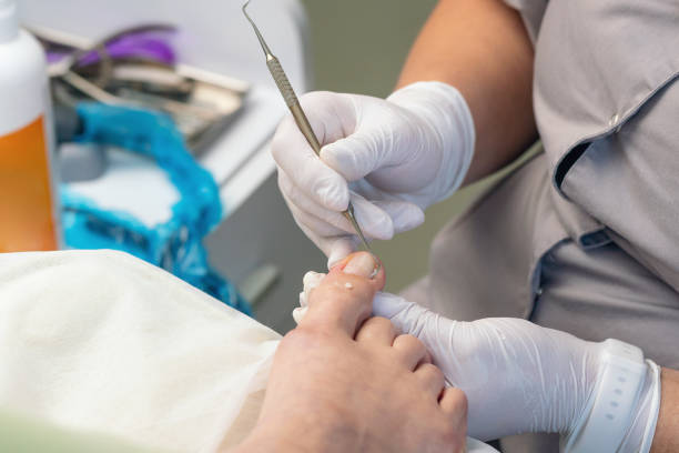istock Podologist uses a curette to remove a callus on the toe 2173997613