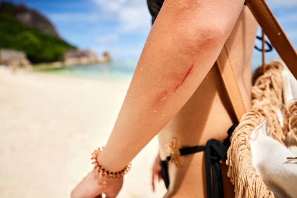 I have a scratch on my arm! Close up of unrecognizable woman having bloody scratch on her arm in summer day on the beach. Copy space. skin scrape stock pictures, royalty-free photos & images