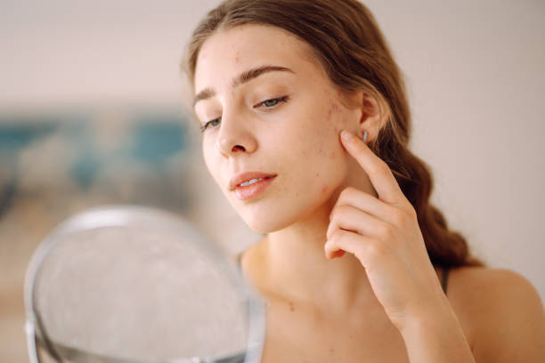 istock A young woman with problem skin is engaged in her skincare routine. 2174158642