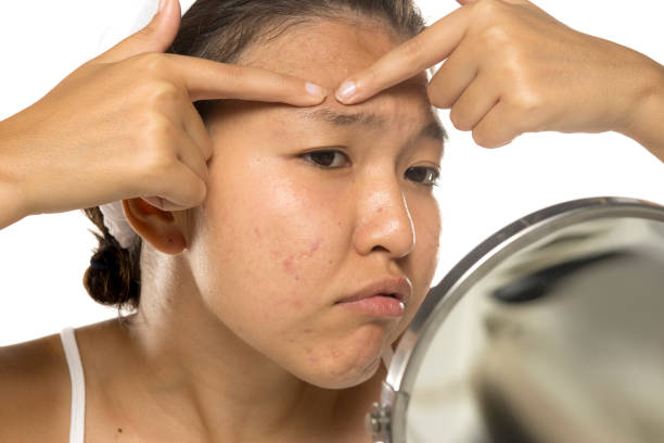 istock Young asian woman Squeezing pimple. 2174210784