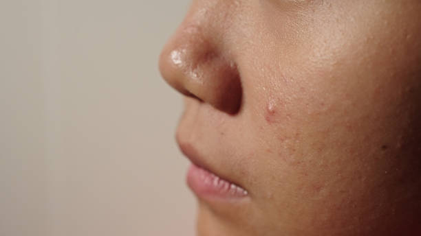istock Close-up acne gel on skin. 2174438277