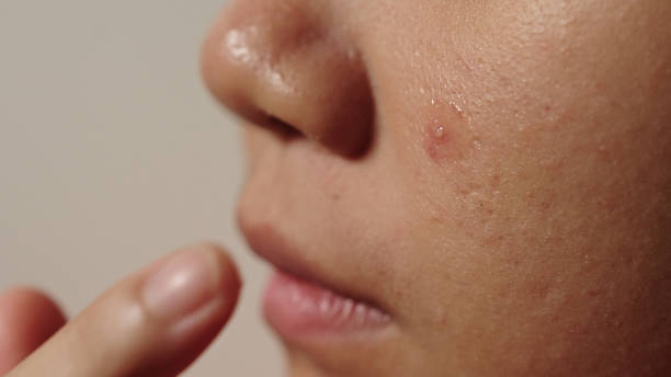 istock Close-up acne gel on skin. 2174438278