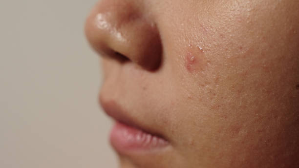 istock Close-up acne gel on skin. 2174438301