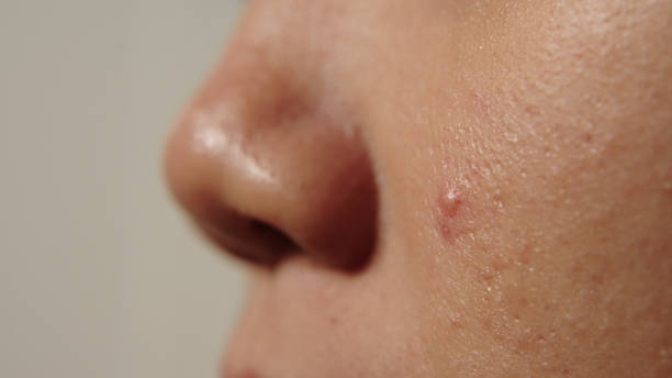 istock Close-up acne gel on skin. 2174438309
