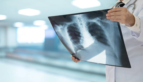 Doctor radiology looking chest or lung x-ray image to diagnose pneumonia or inflamed lungs. medical checkup concept. stock photo