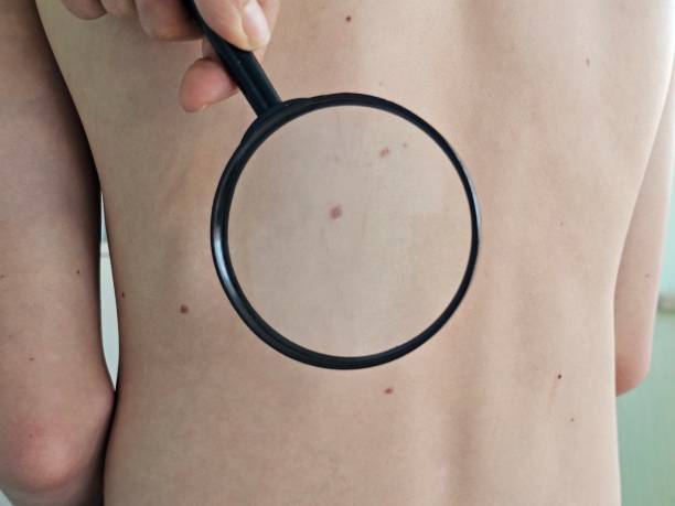 istock Dermatologist examines skin on patient back closeup 2174907275