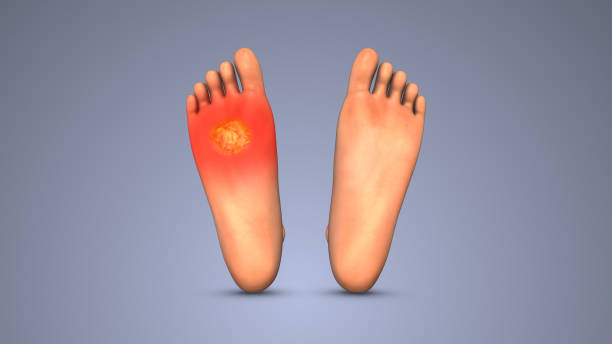istock Symptoms of Diabetic Foot Ulcer 2175185454