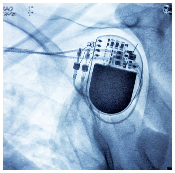 X ray image showed dual chamber permanent pacemaker (PPM) in left chest at Cath Laboratory.