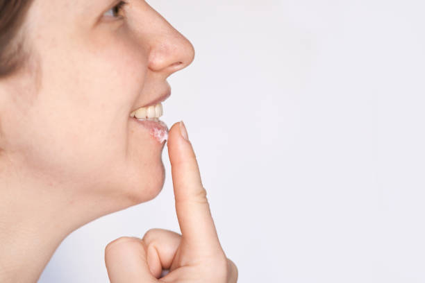 istock Woman applying lip balm on chapped lips for skincare and hydration routine 2175300204