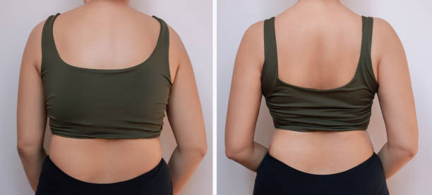 istock A young woman standing with her back bent and straightened. Correct and incorrect spine position. Scoliosis 2175425575