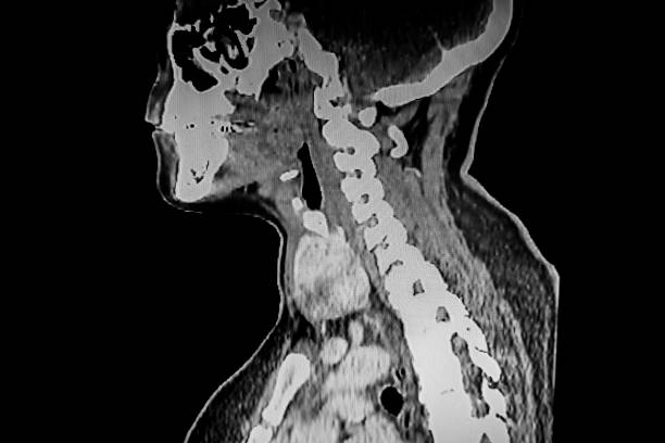 kuvapankkikuvat ja rojaltivapaat kuvat aiheesta kilpirauhasen kasvaimen kissan skannaus - larynx muscles