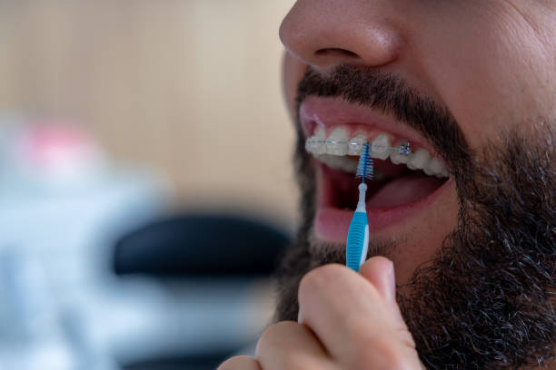 istock Man with crooked teeth and ceramic braces using dental brush to clean around braces 2175578692