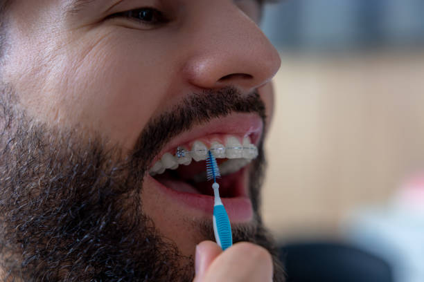 istock Man with metal braces carefully cleaning his teeth using interdental brush 2175578694