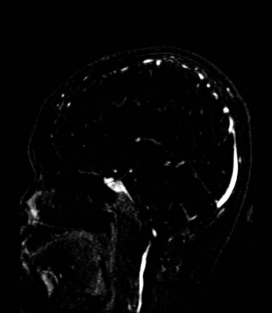 istock A normal MRV brain scan showing clear and healthy venous structures, with no signs of blockages or abnormalities in the cerebral veins, indicating normal blood flow. 2176164900