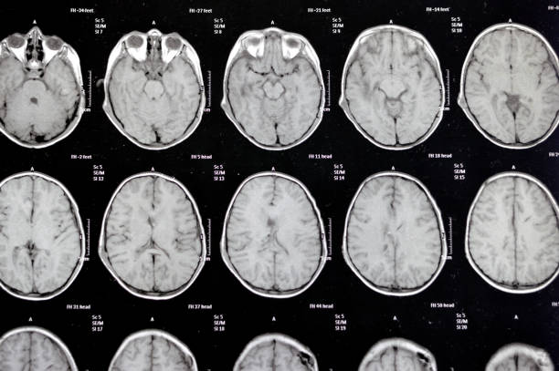 istock MRI of the brain reveals previous shunt operations for a hydrocephalus case, right frontal pre-ventricular para-falcine enhancing lesion 2176427346