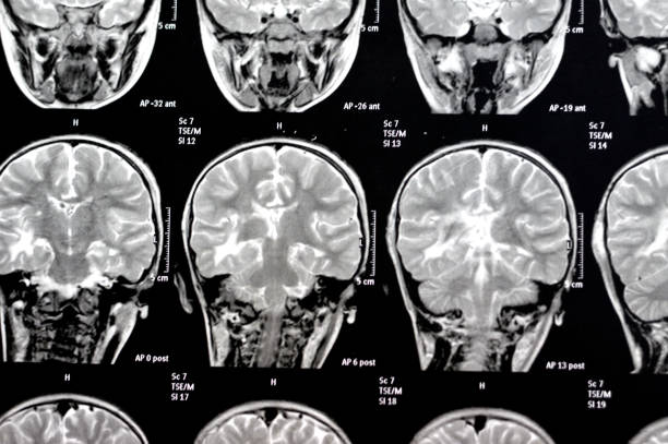 MRI of the brain reveals previous shunt operations for a hydrocephalus case, right frontal pre-ventricular para-falcine enhancing lesion MRI of the brain reveals previous shunt operations for a hydrocephalus case, right frontal pre-ventricular para-falcine enhancing lesion with suspected hemorrhagic component could be neoplastic hematoma images stock pictures, royalty-free photos & images