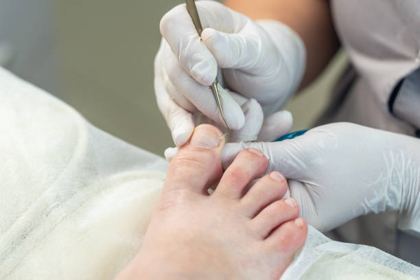 istock Podologist uses a curette to remove a callus on the toe 2176707498