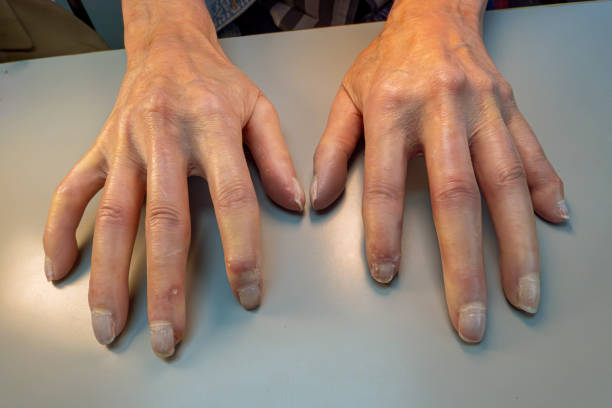 Scleroderma Rash Hand 1,000+ Scleroderma Stock Photos, Pictures & Royalty-Free Images - iStock