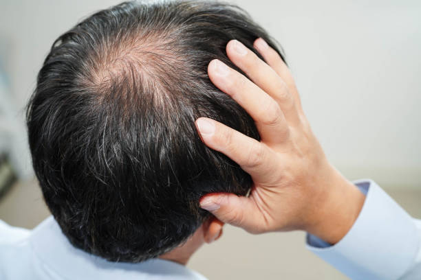 istock Bald head in man, hair loss treatment health problem. 2177430199