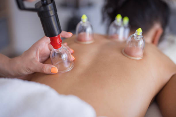 istock Hijama cupping thrapy on women 2177605241