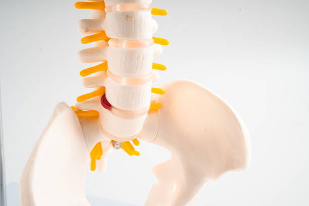 istock Lumbar spine displaced herniated disc fragment, spinal nerve and bone. Model for treatment medical in the orthopedic department. 2177606229