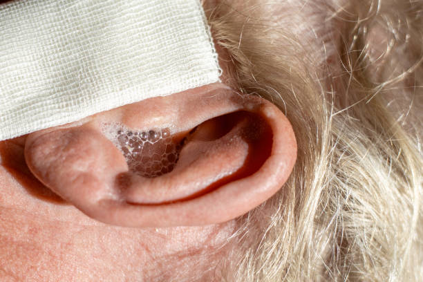 istock Ear diseases. Dropping hydrogen peroxide into a man's ears to soften earwax. Ear with solution bubbles, close-up 2177964162