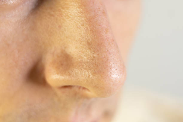 istock Blackheads on mans nose. Acne problem, comedones. Close up. 2178066991