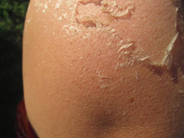 istock A close-up view shows peeling skin on a shoulder, indicating a severe sunburn sustained after spending a day outdoors at the beach in warm weather. 2178104630