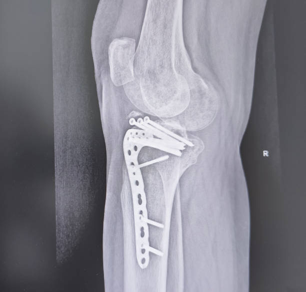 istock Structure of knee and rx-ray image of knee, tibia fracture with post operation internal fixation. 2178174889