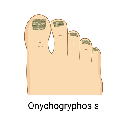 Toenail Onychogryphosis Nail Pathology Ram Horn Nails Stock toenail-onychogryphosis-nail-pathology-ram-horn-nails-stock