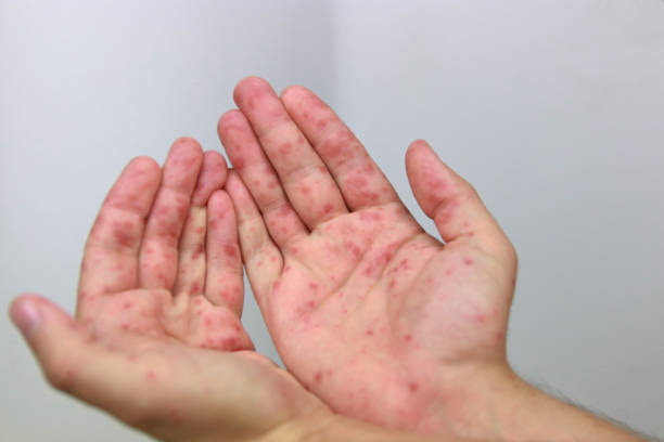 istock Hand foot and mouth disease 2178725646