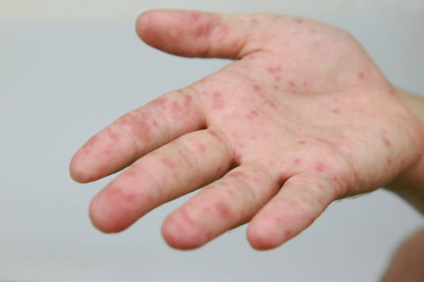 istock Hand foot and mouth disease 2178725653
