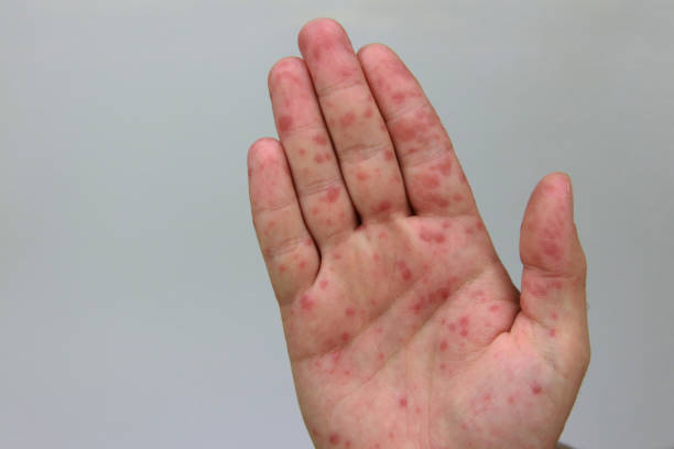istock Hand foot and mouth disease 2178725656