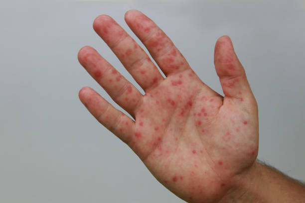 istock Hand foot and mouth disease 2178725670