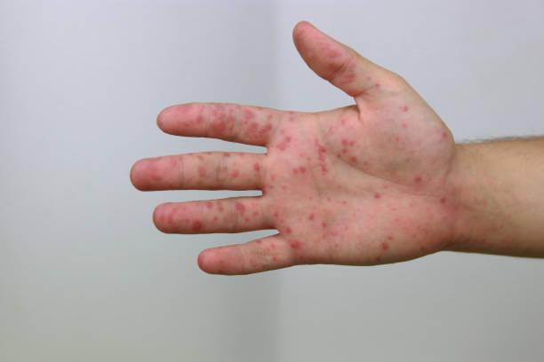 istock Hand foot and mouth disease 2178725671