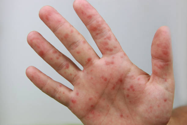 istock Hand foot and mouth disease 2178725793